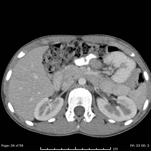 Agenesis of the gallbladder (Radiopaedia 55454-61905 B 36).jpg