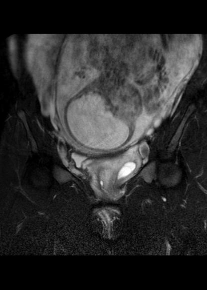 File:Aggressive angiomyxoma of the pelvis and perineum (Radiopaedia 59162-66479 Coronal T2 fat sat 9).jpg