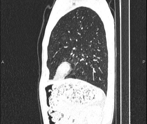 Air bronchogram in pneumonia (Radiopaedia 85719-101512 Sagittal lung window 75).jpg