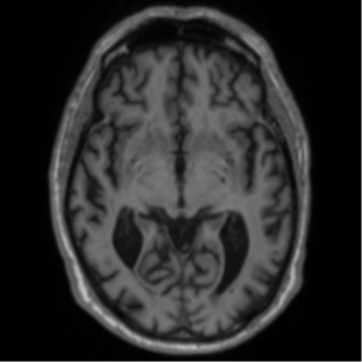 Alzheimer's disease- with Gerstmann syndrome and dressing apraxia (Radiopaedia 54882-61150 Axial T1 34).png