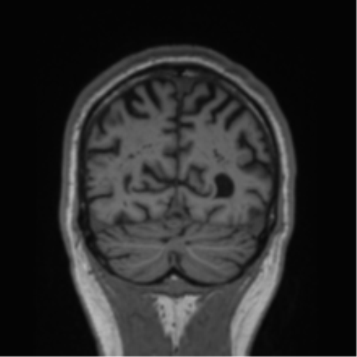 Alzheimer's disease- with Gerstmann syndrome and dressing apraxia (Radiopaedia 54882-61150 Coronal T1 19).png