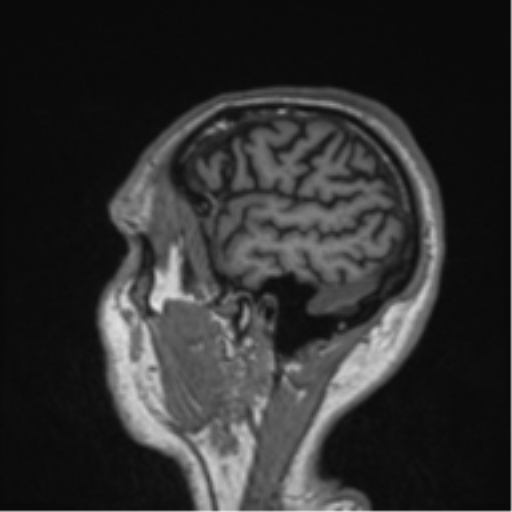 Alzheimer's disease- with Gerstmann syndrome and dressing apraxia (Radiopaedia 54882-61150 Sagittal T1 8).png