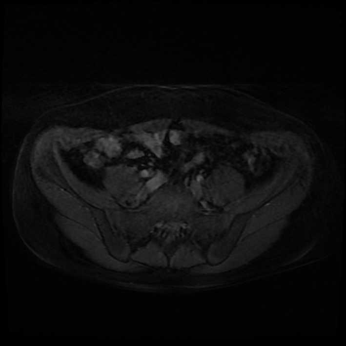 Ambiguous genitalia (Radiopaedia 69686-79643 Axial T1 C+ fat sat 1).jpg