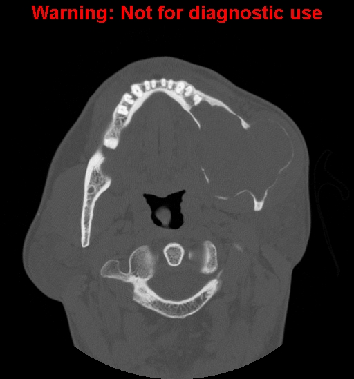 File:Ameloblastoma (Radiopaedia 13276-13280 Axial non-contrast 11).jpg