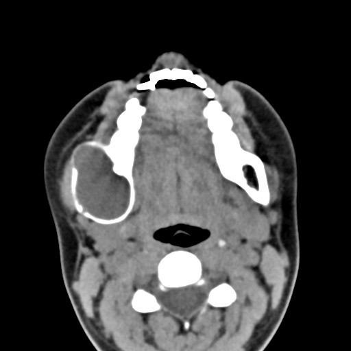 File:Ameloblastoma (Radiopaedia 26645-26793 Axial C+ delayed 16).jpg