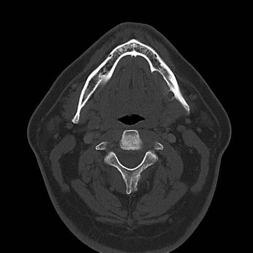 Ameloblastoma (Radiopaedia 38520-40623 Axial bone window 34).png