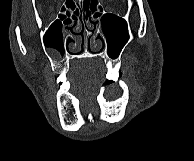 Ameloblastoma (Radiopaedia 51921-57766 Coronal bone window 68).jpg
