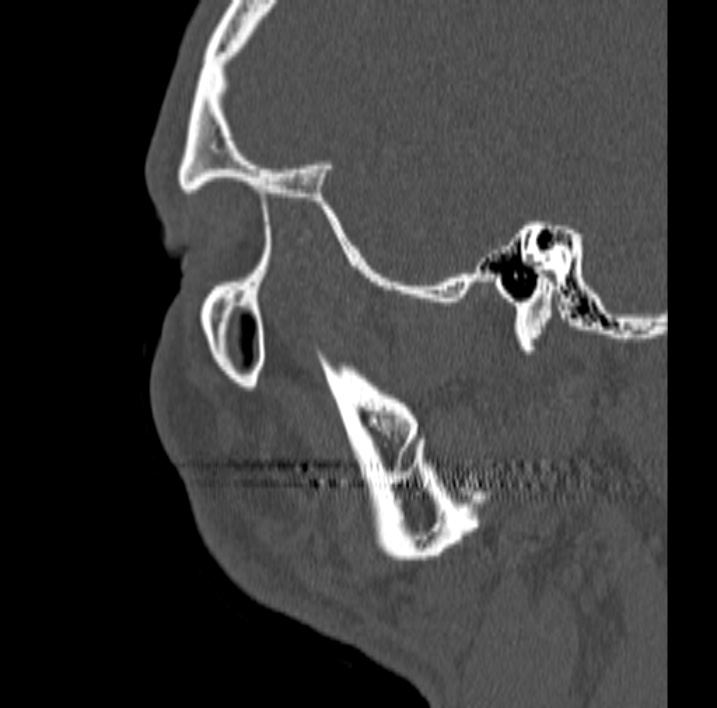 Ameloblastoma (Radiopaedia 77750-89997 Sagittal bone window 93).jpg