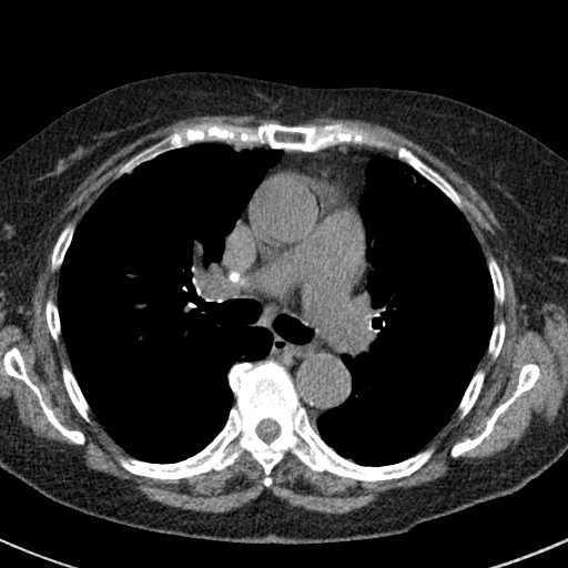 File:Amiodarone-induced pulmonary fibrosis (Radiopaedia 82355-96460 Axial non-contrast 28).jpg