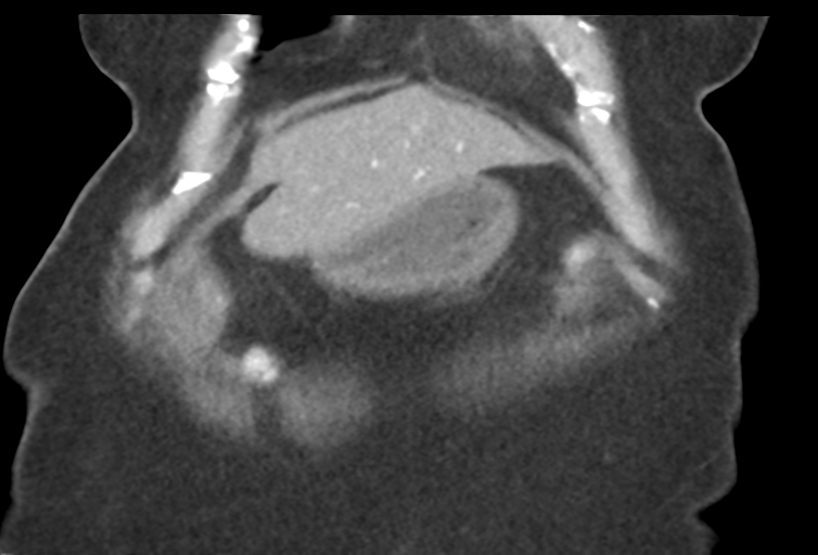 Ampullary adenocarcinoma (Radiopaedia 34013-35241 Coronal 8).png