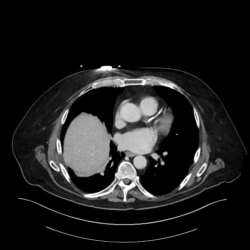 Ampullary adenocarcinoma (Radiopaedia 59373-66734 C 10).jpg