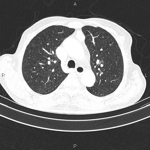 Ampullary adenocarcinoma (Radiopaedia 86093-102033 Axial lung window 26).jpg