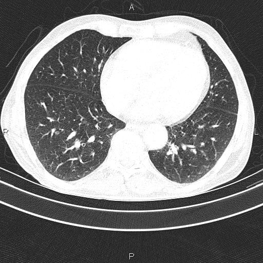 File:Ampullary adenocarcinoma (Radiopaedia 86093-102033 Axial lung window 41).jpg