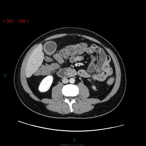 Ampullary carcinoma (Radiopaedia 56396-63056 C 53).jpg