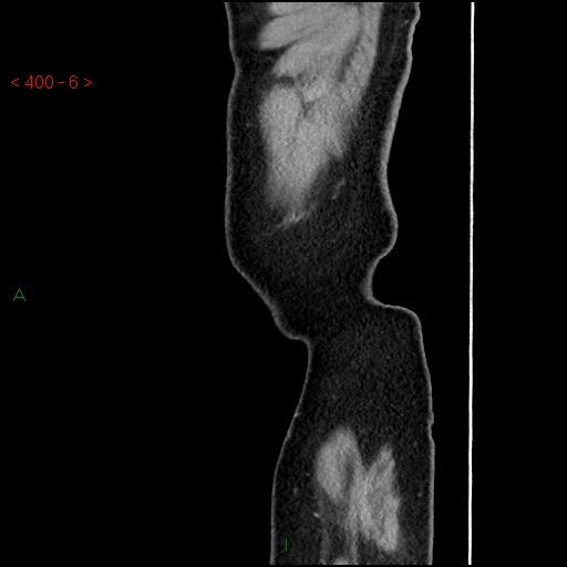 Ampullary carcinoma (Radiopaedia 56396-63056 D 5).jpg