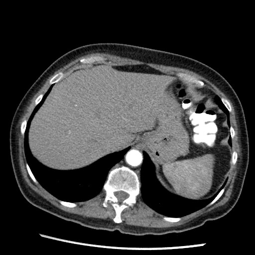 Amyloidosis - bronchial and diffuse nodular pulmonary involvement (Radiopaedia 60156-67745 A 48).jpg
