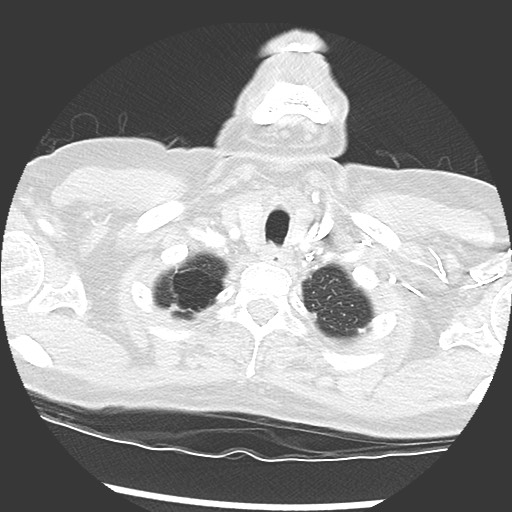 Amyloidosis - bronchial and diffuse nodular pulmonary involvement (Radiopaedia 60156-67745 Axial lung window 3).jpg