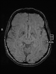 Amyotrophic lateral sclerosis (Radiopaedia 70821-81017 Axial SWI 22).jpg