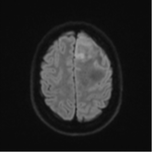 Anaplastic astrocytoma (Radiopaedia 57768-64731 Axial DWI 51).png