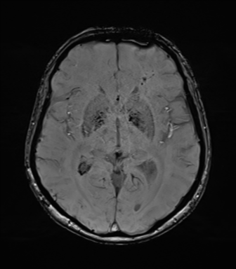 Anaplastic astrocytoma (Radiopaedia 86943-103160 Axial SWI 45).png
