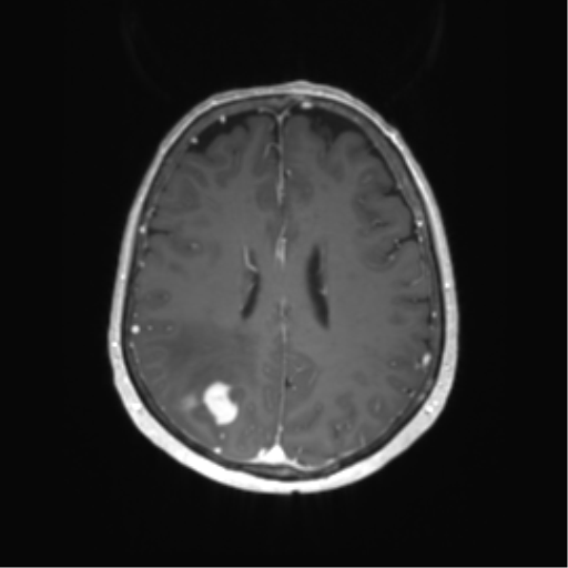 File:Anaplastic astrocytoma (Radiopaedia 86943-103160 Axial T1 C+ 47).png