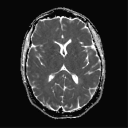 File:Anaplastic astrocytoma IDH mutant (Radiopaedia 50046-55341 Axial ADC 15).png