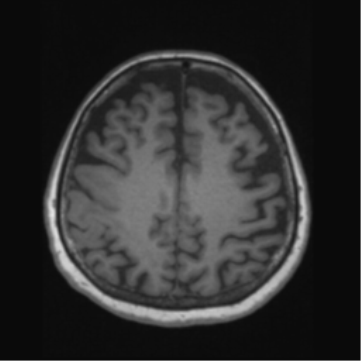 File:Anaplastic astrocytoma IDH wild-type (pseudoprogression) (Radiopaedia 42209-45276 Axial T1 107).png