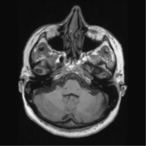 Anaplastic astrocytoma IDH wild-type (pseudoprogression) (Radiopaedia 42209-45276 Axial T1 40).png
