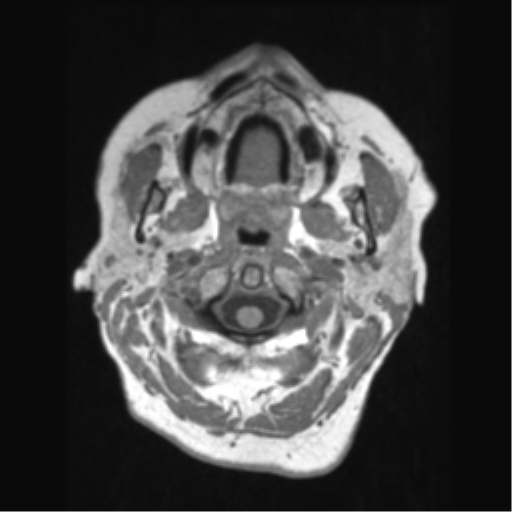 Anaplastic astrocytoma IDH wild-type (pseudoprogression) (Radiopaedia 42209-45276 Axial T1 9).png