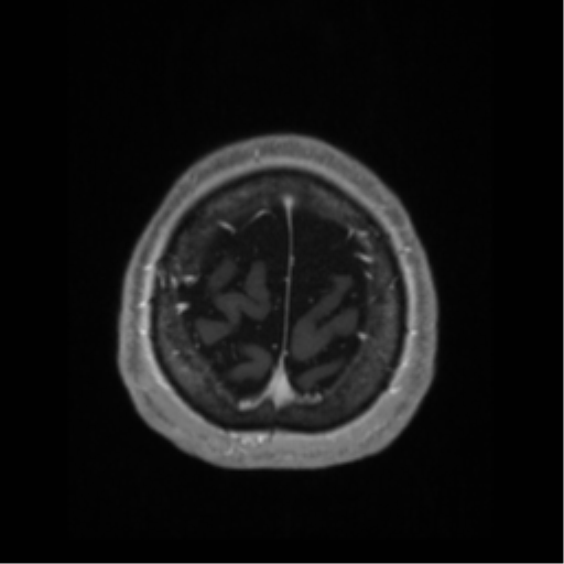 Anaplastic astrocytoma IDH wild-type (pseudoprogression) (Radiopaedia 42209-45276 Axial T1 C+ 133).png