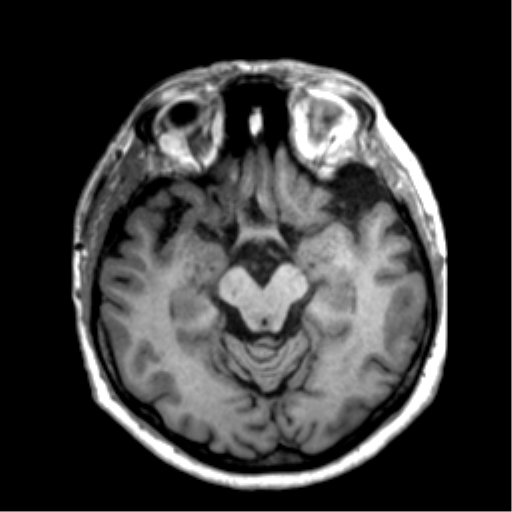 Anaplastic astrocytoma IDH wild-type (pseudoprogression) (Radiopaedia 42209-45277 Axial T1 53).png