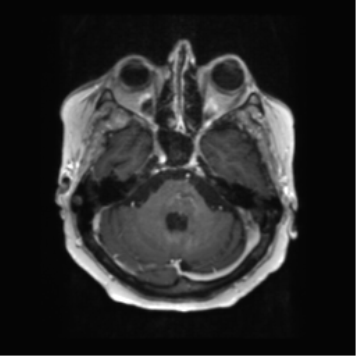 Anaplastic astrocytoma IDH wild-type (pseudoprogression) (Radiopaedia 42209-45279 Axial T1 C+ 42).png