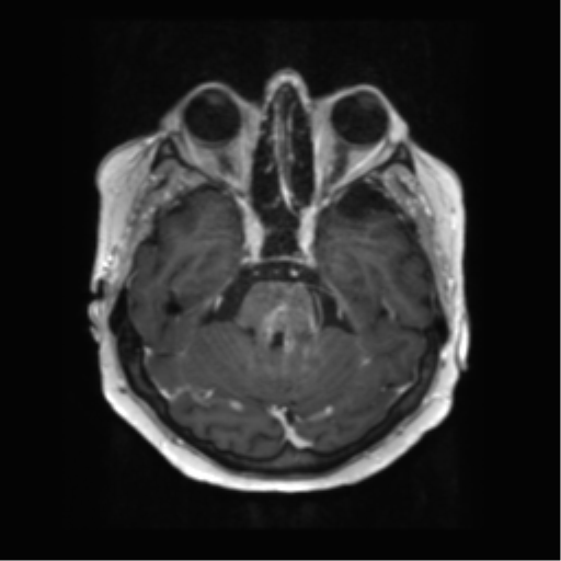 File:Anaplastic astrocytoma IDH wild-type (pseudoprogression) (Radiopaedia 42209-45279 Axial T1 C+ 47).png
