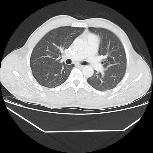 File:Aneurysmal bone cyst - rib (Radiopaedia 82167-96220 Axial lung window 31).jpg