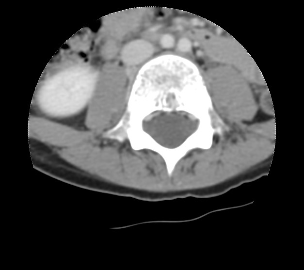 Aneurysmal bone cyst - sacrum (Radiopaedia 65190-74195 Axial non-contrast 1).jpg