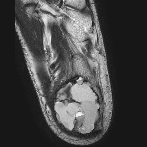 File:Aneurysmal bone cyst of the calcaneus (Radiopaedia 60669-68420 Axial T2 6).jpg