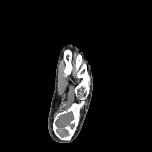 File:Aneurysmal bone cyst of the calcaneus (Radiopaedia 60669-68421 A 34).jpg
