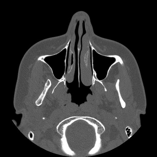 Aneurysmal bone cyst of the mandible (Radiopaedia 43280-46823 Axial bone window 115).jpg