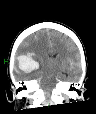 Aneurysmal subarachnoid hemorrhage with intra-axial extension (Radiopaedia 84371-99699 Coronal non-contrast 35).jpg