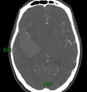 File:Aneurysmal subarachnoid hemorrhage with intra-axial extension (Radiopaedia 84371-99732 A 21).jpg