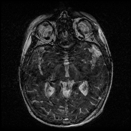 Angioinvasive aspergillosis in the pituitary fossa (Radiopaedia 39676-42010 Ax 3D FIESTA VOLUME 85).png