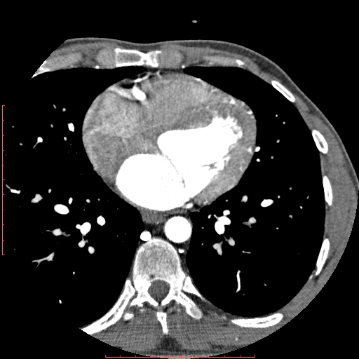 File:Anomalous left coronary artery from the pulmonary artery (ALCAPA) (Radiopaedia 70148-80181 A 197).jpg