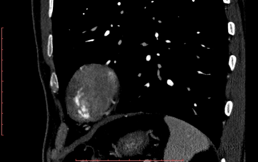 Anomalous left coronary artery from the pulmonary artery (ALCAPA) (Radiopaedia 70148-80181 C 246).jpg