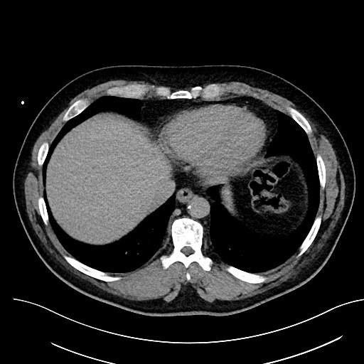 File:Anomalous origin of the left coronary artery with malignant course (Radiopaedia 77842-90126 Axial non-contrast 27).jpeg