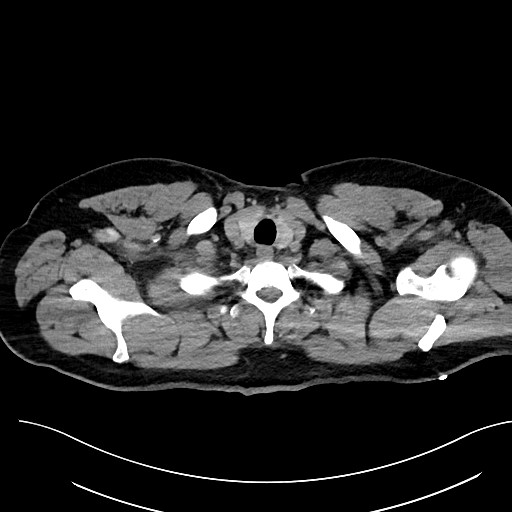 File:Anomalous origin of the left coronary artery with malignant course (Radiopaedia 77842-90126 Axial non-contrast 3).jpeg