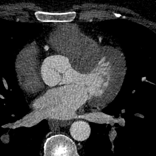 File:Anomalous origin of the left coronary artery with malignant course (Radiopaedia 77842-90126 C 102).jpeg