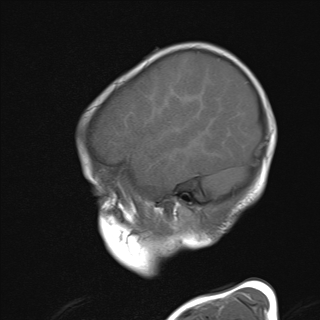 File:Anoxic brain injury (Radiopaedia 79165-92139 Sagittal T1 5).jpg