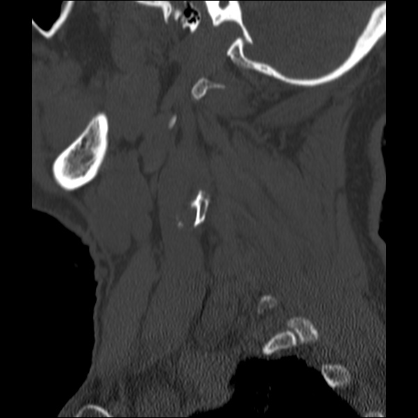 Anterior cervical postdiscectomy arthrodesis (Radiopaedia 32678-33646 Sagittal bone window 5).jpg
