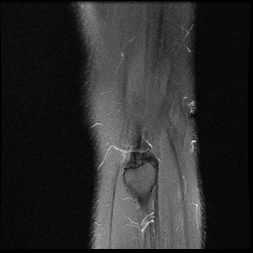 File:Anterior cruciate ligament avulsion fracture (Radiopaedia 58939-66193 Sagittal PD fat sat 2).jpg