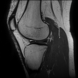 Anterior cruciate ligament rupture and posteromedial corner injury (Radiopaedia 67338-76723 Sagittal PD 113).jpg